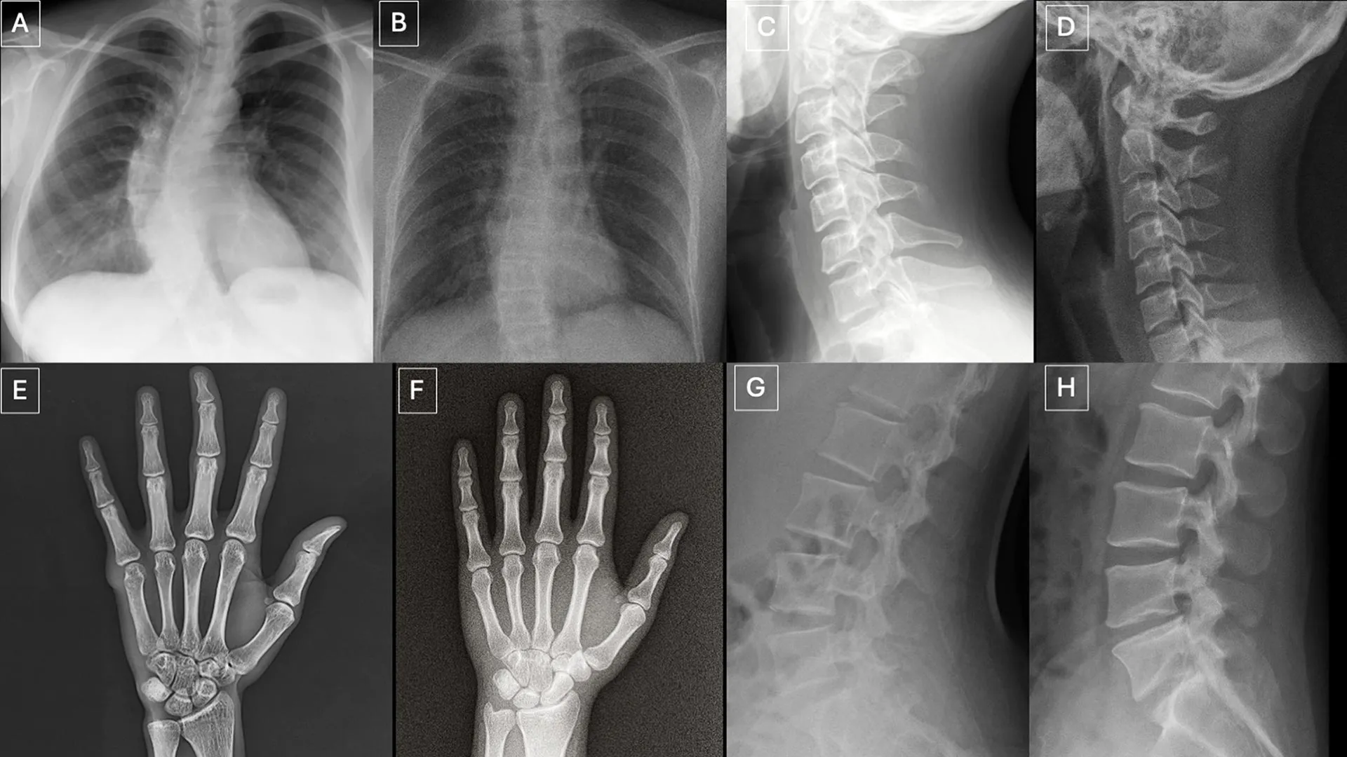 Side-by-side comparison of real and GPT-4o-generated X-rays illustrating how convincing deepfakes have become